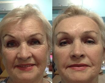 Experience using Goji Cream - personal photo before and after
