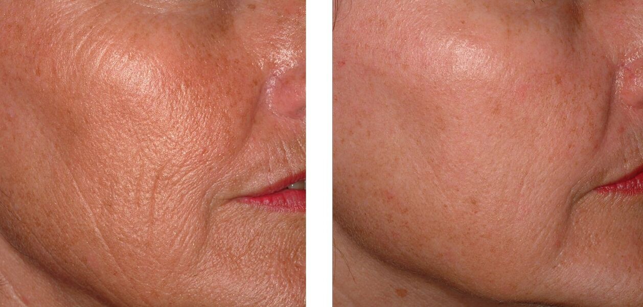 To rejuvenate the skin