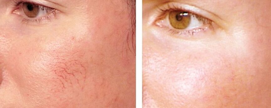 Rosacea