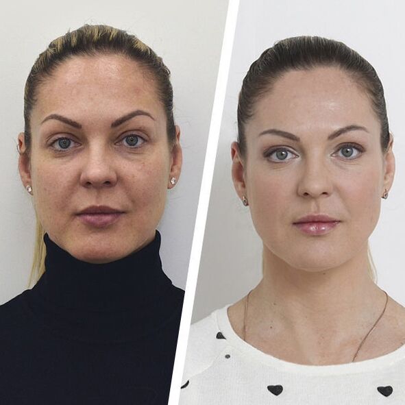 Before facial skin rejuvenation and without surgery