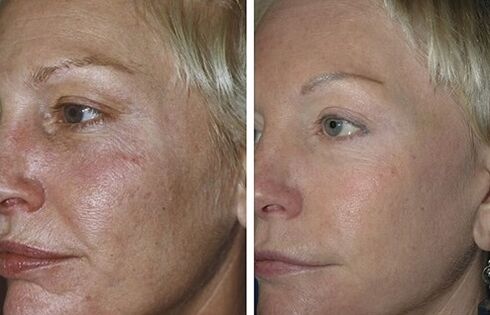 Fractional laser rejuvenation before and after photo
