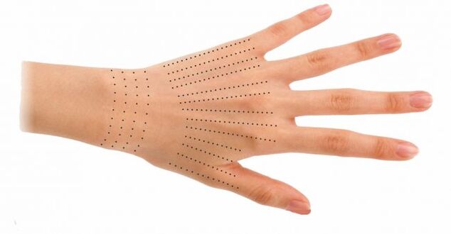 Injection sites of hands during biorevitalization