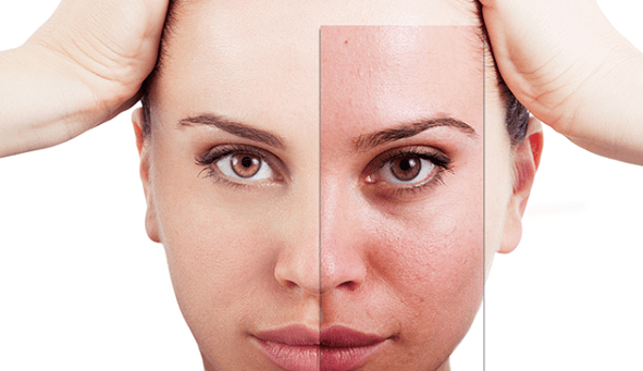 Fractional rejuvenation removes the main aesthetic defects of the face