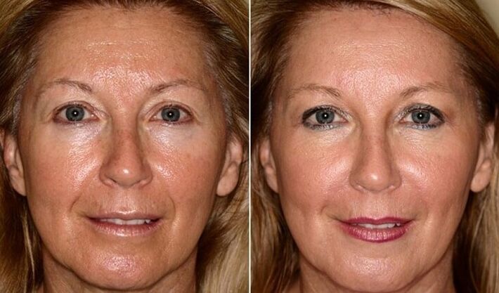Facial skin before and after rejuvenation at home