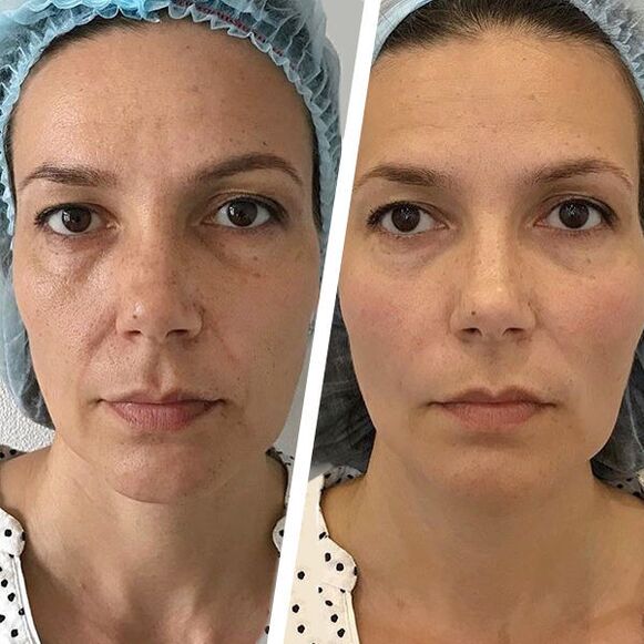 Facial photo before and after laser rejuvenation